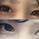 二重埋没 / 目頭切開 新宿美容外科ネビュラクリニック AFTER サムネイル用