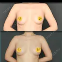 脂肪吸引（脚） / 豊胸（脂肪注入） Lipo Clinic omotesando AFTER サムネイル用