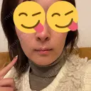 ボトックス（エラ・小顔） / ボトックス（口角） DMTC美容皮膚科 大宮院 AFTER サムネイル用