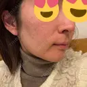 ボトックス（エラ・小顔） / ボトックス（口角） DMTC美容皮膚科 大宮院 DAY 15 サムネイル用