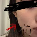 ボトックス（エラ・小顔） DMTC CLINIC 日本橋院 DAY 1 サムネイル用