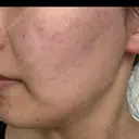 ピーリング（ニキビ・毛穴） / ピーリング（ハリ・ツヤ） 湘南美容クリニック 松戸院 DAY 0 サムネイル用