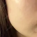 医療脱毛（顔） S-Laboクリニック 渋谷院 AFTER サムネイル用