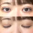 二重切開 EMMA CLINIC（エマクリニック） DAY 41 サムネイル用