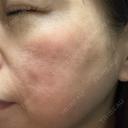 光治療（フォトフェイシャルなど） / RF（高周波）たるみ治療 / ルメッカ / インモード BITO BEAUTY CLINIC DAY 13 サムネイル用