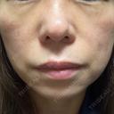 光治療（フォトフェイシャルなど） / RF（高周波）たるみ治療 / ルメッカ / インモード BITO BEAUTY CLINIC DAY 13 サムネイル用
