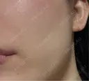 脂肪吸引注射（顔） APスキンクリニック銀座 AFTER サムネイル用