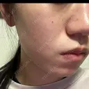 毛穴洗浄（ハイドラフェイシャルなど） / ルメッカ 大美会クリニック 心斎橋本院 DAY 2 サムネイル用