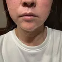 ボトックス（あご） / ボトックス（口角） / ボトックス（眉間） / ボトックス（目尻） / ボトックス（額） / 肌育注射（ジュベルックなど） 千葉美容外科アイビークリニック AFTER サムネイル用