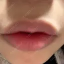 その他（口元） ルラ美容クリニック 大阪心斎橋院 DAY 9 サムネイル用