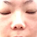 肌ヒアルロン酸注入（たるみ・シワ改善） 博多美容外科/美容皮膚科 ビラビューティークリニック AFTER サムネイル用