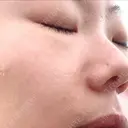 肌ヒアルロン酸注入（たるみ・シワ改善） 博多美容外科/美容皮膚科 ビラビューティークリニック DAY 2 サムネイル用