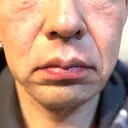 RF（高周波）たるみ治療 plume clinic DAY 7 サムネイル用