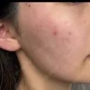 ピーリング（ニキビ・毛穴） / ピーリング（ハリ・ツヤ） 湘南美容クリニック 松戸院 AFTER サムネイル用