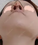 隆鼻術 / 鼻尖形成（切開） / 鼻中隔延長（切開） / 軟骨移植 / 骨切幅寄せ / 鼻孔縁挙上 / 鼻翼基部形成（貴族手術） / 鼻柱下降・鼻唇角形成（猫手術） WOM CLINIC GINZA （ワム クリニック ギンザ） DAY 9 サムネイル用