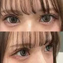 ヒアルロン酸注入（涙袋） 新未来クリニック AFTER サムネイル用