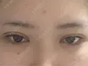 二重埋没 TCB東京中央美容外科 奈良院 DAY 0 サムネイル用