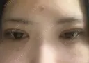 二重埋没 TCB東京中央美容外科 奈良院 DAY 0 サムネイル用
