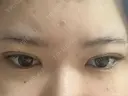 二重埋没 TCB東京中央美容外科 奈良院 DAY 2 サムネイル用