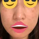 プラセンタ注射 / シミ取りレーザー 仁愛クリニック DAY 82 サムネイル用