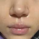 ボトックス（口角） / ヒアルロン酸注入（鼻翼基部） ルラ美容クリニック 大阪本院 AFTER サムネイル用