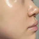 ボトックス（口角） / ヒアルロン酸注入（鼻翼基部） ルラ美容クリニック 大阪本院 DAY 3 サムネイル用