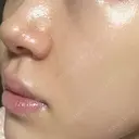 ボトックス（口角） / ヒアルロン酸注入（鼻翼基部） ルラ美容クリニック 大阪本院 DAY 3 サムネイル用