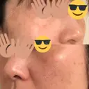 プラセンタ注射 / シミ取りレーザー 仁愛クリニック DAY 82 サムネイル用