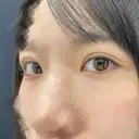 二重埋没 東京シンデレラ美容外科 池袋院 AFTER サムネイル用