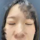 二重埋没 東京シンデレラ美容外科 池袋院 DAY 32 サムネイル用