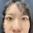 二重埋没 東京シンデレラ美容外科 池袋院 DAY 32 サムネイル用