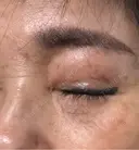 ほくろ・いぼ切除（肌） ルラ美容クリニック 横浜院 DAY 0 サムネイル用