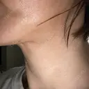 ヒアルロン酸溶解 / インモード Moon Beauty Clinic DAY 1 サムネイル用