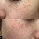 ピーリング（ハリ・ツヤ） / ルメッカ ルラ美容クリニック 札幌本院 DAY 0 サムネイル用