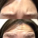 ボトックス（あご） / ボトックス（エラ・小顔） / ボトックス（口角） / ボトックス（眉間） / ボトックス（額） / ボトックス（首） 大美会クリニック 神戸院 DAY 1 サムネイル用