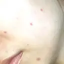 ほくろ・いぼ切除（肌） フローラクリニック DAY 14 サムネイル用