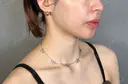 その他（鼻） / 鼻孔縁下降 アリエル美容クリニック 大宮院 DAY 94 サムネイル用