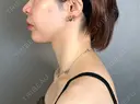 その他（鼻） / 鼻孔縁下降 アリエル美容クリニック 大宮院 DAY 94 サムネイル用