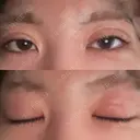 二重埋没 形成外科と美容外科のクリニック池袋 DAY 7 サムネイル用