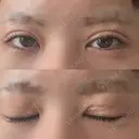 二重埋没 形成外科と美容外科のクリニック池袋 DAY 8 サムネイル用