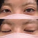 二重埋没 形成外科と美容外科のクリニック池袋 DAY 10 サムネイル用