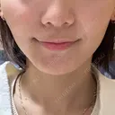 ボトックス（エラ・小顔） / ピアス穴あけ ルラ美容クリニック 横浜院 DAY 56 サムネイル用