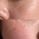 ピーリング（ハリ・ツヤ） / ルメッカ ルラ美容クリニック 札幌本院 DAY 1 サムネイル用