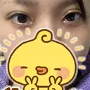 目頭切開 新宿美容外科ネビュラクリニック DAY 2 サムネイル用