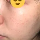 ピーリング（ニキビ・毛穴） / 光治療（フォトフェイシャルなど） ルラ美容クリニック 横浜院 DAY 5 サムネイル用