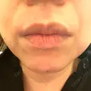 医療脱毛（顔） ゆきおかクリニック AFTER サムネイル用