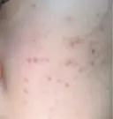 その他（肌） / ポテンツァ ルラ美容クリニック 郡山院 DAY 3 サムネイル用