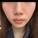 ボトックス（エラ・小顔） 新未来クリニック AFTER サムネイル用