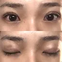 二重埋没 / その他（目元） / 目元修正 湘南美容クリニック 札幌院 DAY 9 サムネイル用