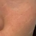 美肌レーザー LEX BEAUTY CLINIC DAY 3 サムネイル用